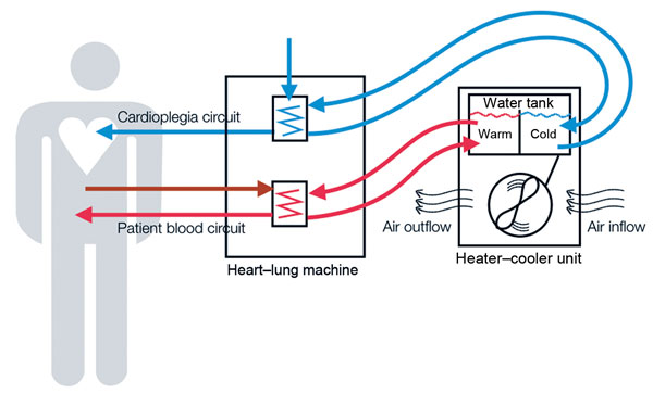 Schematic representation of heater–cooler circuits tested for transmission of Mycobacterium chimaera during cardiac surgery despite an ultraclean air ventilation system. Blue arrows indicate cold water flow, and red arrows indicate hot water flow and patient blood flow.