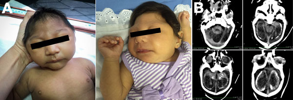 Microcephaly, Pernambuco State, Brazil, 2015. A) Two newborns in whom microcephaly was diagnosed during the epidemic. B) Brain computed tomography scan of a 43-day-old infant showing cerebellar hypoplasia, parenchymal calcifications, ventriculomegaly, and malformation of cortical development compatible with lissencephaly.