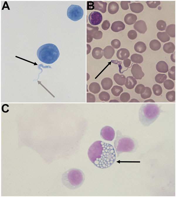 A) Cytological slide prepared from cerebrospinal fluid (CSF) from a child with congenital trypanosomiasis who was born in France to an African mother (Gram staining, original magnification ×1,000). B) Blood smear from the child (May-Grunewald Giemsa [MGG] staining, original magnification ×1,000). C) Mott cell in the mother’s CSF (MGG staining, original magnification ×1,000). Trypomastigote forms of Trypanosoma brucei are extracellular structures, 2 × 25 μm, with a terminal flagellum (gray arrow,