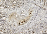 Thumbnail of Spleen of the youngest female sperm whale (SW3) in study of 7 sperm whales stranded along Italy’s Adriatic coastline in September 2014. Positive immunostaining (Mayer’s hematoxylin counterstain) for morbilliviral antigen is shown in monocytes within vascular lumina and in follicular dendritic-like cells in the splenic white pulp. Morbillivirus immunohistochemistry was conducted with a murine monoclonal antibody against canine distemper virus nucleoprotein (VMRD Inc., Pullman, WA, US