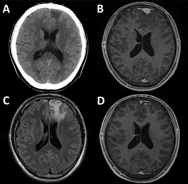 Diagnostic imaging results for a brain mass in a 21-year-old HIV-positive man with cerebral syphilitic gumma in Tokyo, Japan, for whom serum samples obtained as recently as 5 months earlier showed negative results for syphilis. A) Noncontrast, cranial computed tomography showing a hypodense lesion in the left frontal lobe. B) Gadolinium-enhanced, axial, T1-weighted magnetic resonance imaging (MRI) showing an enhanced lesion (mass) (14 × 14 × 12 mm) adjacent to the enhanced dura in the left front