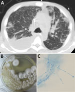 Thumbnail of Emmonsia sp. infection in a 55-year-old man who received an orthotopic liver transplant. A) Chest computed tomography scan showing right pleural effusion and diffuse centrilobular nodules. B) Velvety white colonies of Emmonsia sp. (Sabouraud dextrose agar plate) isolated from the patient. C) Colonies stained with lactophenolcotton blue showing hyphae and conidiophores (blue) (incubated at 30°C) (original magnification ×400).