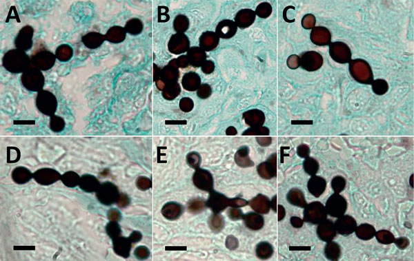 Infected tissues from 6 bottlenose dolphins (Tursiops truncatus) with paracoccidioidomycosis ceti, Indian River Lagoon, Florida, USA, showing typical branching chains of yeast-like cells of Paracoccidioides brasiliensis connected by small isthmuses. A) Strain FB-921; B) FB-938; C) FB-946; D) FB-952; E) B92-932; F) SW070458. Gomori’s methenamine silver stained. Scale bars indicate 10 µm.