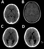 Thumbnail of Neuroimaging during course of illness for a patient with a fatal infection of Murray Valley encephalitis virus imported from Australia to Canada, 2011. Each image corresponds to an axial cross-section through the thalamus and basal ganglia. A) Computed tomography (CT) at day 3. B) Magnetic resonance imaging (T2 flipped attenuation inversion recovery sequence) at day 3 showing abnormalities in the posterior thalami and splenium of the corpus callosum. C) CT when a fixed, dilated, rig