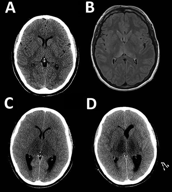 Neuroimaging during course of illness for a patient with a fatal infection of Murray Valley encephalitis virus imported from Australia to Canada, 2011. Each image corresponds to an axial cross-section through the thalamus and basal ganglia. A) Computed tomography (CT) at day 3. B) Magnetic resonance imaging (T2 flipped attenuation inversion recovery sequence) at day 3 showing abnormalities in the posterior thalami and splenium of the corpus callosum. C) CT when a fixed, dilated, right pupil (day