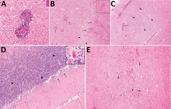 Hematoxylin and eosin–stained autopsy specimens from a patient with a fatal infection of Murray Valley encephalitis virus imported from Australia to Canada, 2011. A) Pons showing perivascular inflammatory infiltrate (original magnification ×40). B) Thalamus showing extensive inflammation (arrows) surrounding an area of rarefaction caused by necrosis (arrowheads) and neuronal loss (original magnification ×10); inset shows a microglial nodule (original magnification ×20). C) Pyramidal cell layer o