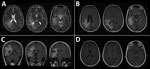 Thumbnail of Magnetic resonance imaging of the brain of a 46-year-old immunocompromised woman with central nervous system brucellosis granuloma and white matter disease, Saudi Arabia. A) Axial T2 images showing hyperintensity in the right frontoparietal lobe and right temporal lobe. B) Axial fluid-attenuated inversion recovery (FLAIR) and C) coronal FLAIR images showing that hypersensitivity extends to U-fibers without involvement of the cortex. D) Gadolinium-enhanced image showing that no appre