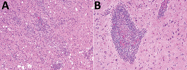 Histologic analysis of a brain biopsy specimen from a 46-year-old immunocompromised woman with central nervous system brucellosis granuloma and white matter disease, Saudi Arabia. A) Low magnification view of cerebral cortex showing infiltration by perivascular lymphocytes and histiocytes. Histiocytes form small nonnecrotizing granuloma (center) (original magnification ×100). B) High magnification view showing an angiocentric epithelioid granuloma cuffed by mature lymphocytes (original magnifica