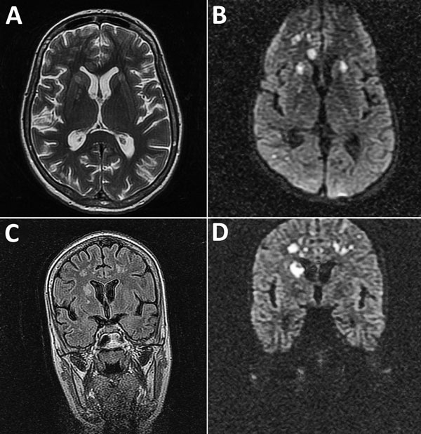 Magnetic resonance imaging of the brain of a 28-year-old woman (patient 1) who had neurologic complications of influenza B virus infection, Romania. A) Axial T2 image showing multiple areas of T2-associated hyperintense lesions with involvement of the genu corpus callosum, bilateral internal capsule, and several areas of white matter in the right frontal lobe, and more discreetly at the limit between the right parietal and occipital lobe. B) Axial diffusion-weighted image showing restricted diff