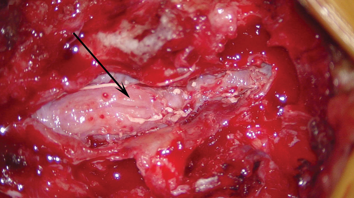 Intraoperative image demonstrating postevacuation cauda equina nerve roots that are grossly edematous and adherent (arrow), consistent with arachnoiditis, in a patient with recurrent infection from fungal-contaminated methylprednisolone, North Carolina, USA, 2015.