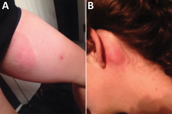 Cutaneous manifestations of Loa loa (African eye worm) infection in a US traveler who returned from a 6-month stay on Bioko Island, Equatorial Guinea, 2016. Urticarial lesions on the left thigh showing a coincident papular eruption (A) and behind the left ear (B).