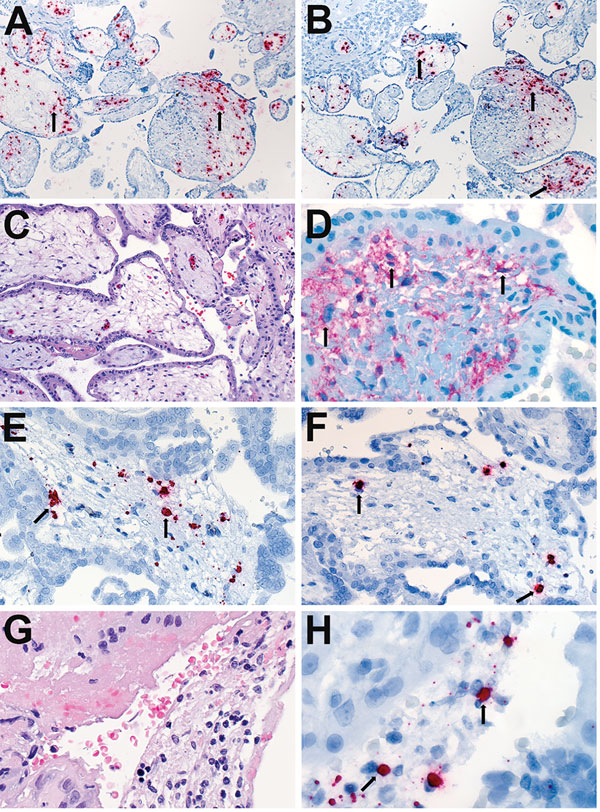 Localization of Zika virus RNA by ISH in placental tissues of women after spontaneous abortion. A) ISH with use of antisense probe. Zika virus genomic RNA localization in placental chorionic villi, predominantly within Hofbauer cells (red stain, arrows), of a case-patient who had spontaneous abortion at 11 wk gestation (case-patient no. 56). Original magnification ×10). B) ISH with use of sense probe. Serial section showing negative–strand replicative RNA intermediates (red stain, arrows) in the