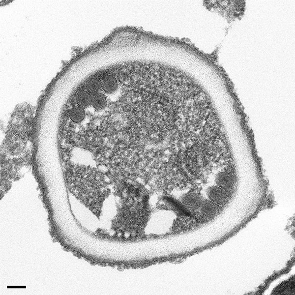 Transmission electron microscopy of microsporidia identified in allograft samples from right kidney recipient. The organism shows cross-sections through the polar tube with up to 6 coils and a unikaryotic nucleus, which is characteristic of Encephalitozoon cuniculi. Scale bar indicates 100 nm. 