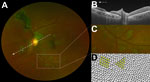 Thumbnail of Characteristic features of lesions observed in a case–control study of ocular signs in Ebola virus disease survivors, Sierra Leone, 2016. A) Composite scanning laser ophthalmoscope retinal image, left eye. Arrow indicates direction of the optical coherence tomography scan. B) Optical coherence tomography. White, long, dashed line indicates cross-sectional plane; white arrowhead indicates Ebola lesion limited to the retinal layers with an intact retinal pigment epithelium. Magnified 