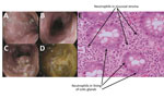 Thumbnail of Endoscopic imagery of the distal sigmoid colon (A), proximal sigmoid colon (B), descending colon (C), and base of cecum (D), revealing diffuse colitis with mucosal erythema, edema, and mucopurulent exudate without ulceration. Colonic biopsy (E) demonstrating  neutrophilic infiltrates (indicated with arrows) in the epithelial lining of the colic glands and the mucosal stroma compatible with mild active colitis without signs of chronicity.