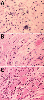 Thumbnail of Pathology findings for case 2, involving a fetus examined after pregnancy termination who had severe neurologic defects attributed to maternal Zika virus infection, Colombia. A) Spinal cord slice showing neuropil disruption with multiple calcifications (arrowheads). B) Nerve showing disruptive changes of axons (Wallerian degeneration) (black star). C) Dorsal root ganglion showing spinal ganglion with satellitosis (arrow) and neuronophagia of ganglion cells (arrowhead). Hematoxylin a