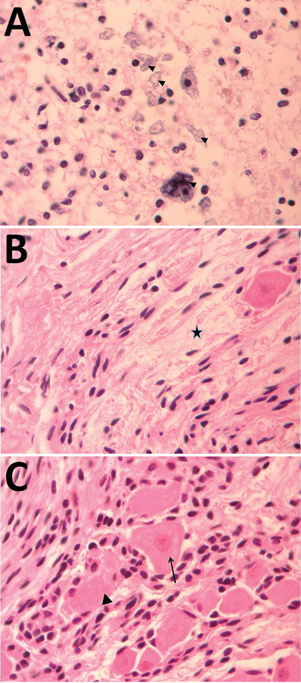 Pathology findings for case 2, involving a fetus examined after pregnancy termination who had severe neurologic defects attributed to maternal Zika virus infection, Colombia. A) Spinal cord slice showing neuropil disruption with multiple calcifications (arrowheads). B) Nerve showing disruptive changes of axons (Wallerian degeneration) (black star). C) Dorsal root ganglion showing spinal ganglion with satellitosis (arrow) and neuronophagia of ganglion cells (arrowhead). Hematoxylin and eosin stai