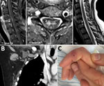 Thumbnail of Images of woman with transverse myelitis and Bartonella henselea infection. A) Magnetic resonance image of the spine showing transverse myelitis. Fat-saturated (fs) T1-weighted image with contrast medium (cm), sagittal plane (left panel) and axial plane (middle panel). T2-weighted image, sagittal plane (right panel). B) Coronal view of computed tomography image of the chest, showing right axillar lymphadenopathy (arrows). C) Right index finger, showing a persistent ulcer from a cat 