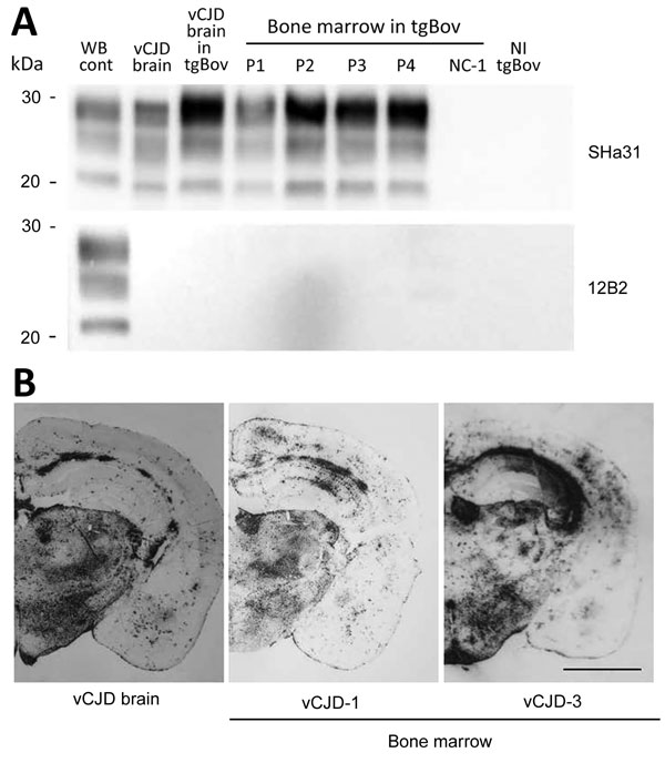 Detection of proteinase K–resistant prions (PrPres) by using Western blotting and paraffin-embedded tissue (PET) blotting of brains of transgenic mice expressing bovine PrP (tgBov). A) PrPres WB of a vCJD sample (frontal cortex), tgBov mice (brain) inoculated with the same vCJD reference isolate, bone marrow samples from vCJD-affected patients (vCJD 1–vCJD-4 [P1–P4]; Table 2), and a non–vCJD control (NC-1; Table 2). A scrapie isolate (WB cont) and a noninoculated tgBov brain (vCJD brain) homogen