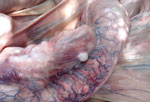 Thumbnail of Intestine from a wild bull elephant, estimated at 20 years of age, Wayanad Wildlife Sanctuary, India, 2007. Multiple white-to-tan discrete nodules (granulomas) are protruding from the serosal surface, and less well-defined areas of pale discoloration are visible within the intestinal wall. Serosal blood vessels are markedly dilated, tortuous, and congested.
