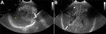 Thumbnail of Standard echography cranial ultrasound of premature infant with Bacillus cereus sepsis, Nice, France, 2013. A) Left sagittal section showing large hemorrhagic hyperechogenic area of white material (white arrow). B) Frontal section showing right periventricular kystic hypoechogenic lesions (white arrow) with associated bilateral hemorrhagic hyperechogenic lesions (white star). 