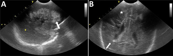 Standard echography cranial ultrasound of premature infant with Bacillus cereus sepsis, Nice, France, 2013. A) Left sagittal section showing large hemorrhagic hyperechogenic area of white material (white arrow). B) Frontal section showing right periventricular kystic hypoechogenic lesions (white arrow) with associated bilateral hemorrhagic hyperechogenic lesions (white star). 