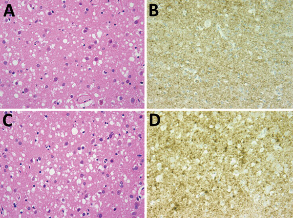 Results of neuropathologic examinations of the brains of the 2 patients with sporadic Creutzfeldt-Jakob disease, United Kingdom, 2014. A) Microvacuolar spongiform change in the frontal cortex (case 1). Hematoxylin and eosin stain; original magnification ×400. B) Fine granular/synaptic accumulation of abnormal prion protein in the cerebral cortex (case 1). 12F10 antiprion protein antibody; original magnification ×400. C) Microvacuolar spongiform change with neuronal loss and gliosis in the fronta