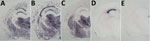 Thumbnail of Protease-resistant prion protein distribution pattern in brains of prion protein humanized transgenic mice inoculated with variant Creutzfeldt-Jakob disease (vCJD) on second passage. A, B) TgMet129 mice inoculated with vCJD. C) TgMet/Val129 mice inoculated with vCJD. D, E) TgVal129 mice inoculated with vCJD propagated in TgMet129 mice. Original magnification ×20 for all panels.