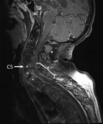 Thumbnail of Fat-saturated, contrast-enhanced T1-weighted magnetic resonance image of the spine of a 59-year-old man (snake keeper) with rat bite fever. Sagittal view of the cervical spine shows spondylodiscitis (*) and an epidural absess with C5–T1 compression (brace). Preexisting spinal degeneration was observed and was probably a promoting factor for spinal compression.