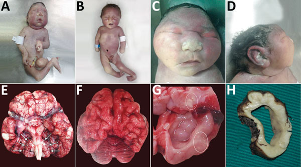 Physical signs in 4 of 7 neonates who died of congenital Zika virus infection, Brazil. A) Neonate 1: typical microcephaly phenotype; arthrogryposis in upper and lower limbs. B) Neonate 7: microcephaly without the typical microcephaly phenotype; arthrogryposis is also present. C) Neonate 3: typical microcephaly phenotype, with head circumference within reference limits, frontal view. D) Neonate 3: typical microcephaly phenotype, with head circumference within reference limits, profile view. E) Br