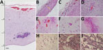 Thumbnail of Histologic slides of tissues from 4 of 7 neonates who died of congenital Zika virus infection, Brazil. A) Neonate 1: severe cortical thinning (3 mm) with subventricular dystrophic calcification, reactive gliosis, and marked leptomeningeal congestion as well as marked depletion of neuronal precursors (original magnification ×10). B) Neonate 1: severe thinning of brain parenchyma (0.8 mm) with striking depletion of neuronal precursors (original magnification ×10). C) Neonate 1: lympho