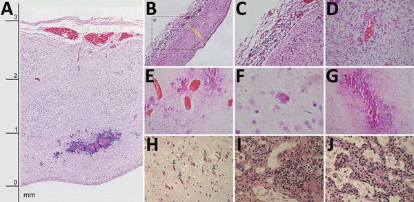 Histologic slides of tissues from 4 of 7 neonates who died of congenital Zika virus infection, Brazil. A) Neonate 1: severe cortical thinning (3 mm) with subventricular dystrophic calcification, reactive gliosis, and marked leptomeningeal congestion as well as marked depletion of neuronal precursors (original magnification ×10). B) Neonate 1: severe thinning of brain parenchyma (0.8 mm) with striking depletion of neuronal precursors (original magnification ×10). C) Neonate 1: lymphocytic leptome