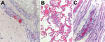 Thumbnail of Histologic slides of autopsy tissue from patients who acquired Rocky Mountain spotted fever in northern Mexico and died at hospitals in the United States, 2013–2016. A) Immunohistochemical stain of Rickettsia rickettsii antigens (red) in inflamed blood vessel adjacent to eccrine gland in a skin biopsy specimen from case-patient 1. Immunoalkaline phosphatase with naphthol-fast red and hematoxylin counterstain; original magnification ×50. B) Diffuse pulmonary capillaritis in case-pati