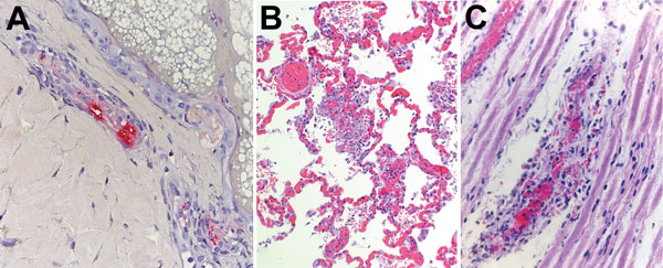 Histologic slides of autopsy tissue from patients who acquired Rocky Mountain spotted fever in northern Mexico and died at hospitals in the United States, 2013–2016. A) Immunohistochemical stain of Rickettsia rickettsii antigens (red) in inflamed blood vessel adjacent to eccrine gland in a skin biopsy specimen from case-patient 1. Immunoalkaline phosphatase with naphthol-fast red and hematoxylin counterstain; original magnification ×50. B) Diffuse pulmonary capillaritis in case-patient 4. Hemato