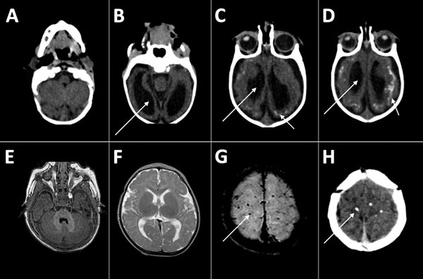 Thumbnail of Computed tomography radiographs of the brains of 2 infants with dysphagia and microcephaly caused by congenital Zika virus infection, Brazil, 2015. A–D) Images for patient 4 show malformation of cortical development, ventriculomegaly (long arrows), and calcifications in cortical and subcortical white matter in transition between cortex and white matter (short arrows). E–H) Images for patient 6 show no malformation of cortical development or ventriculomegaly, but calcifications are v