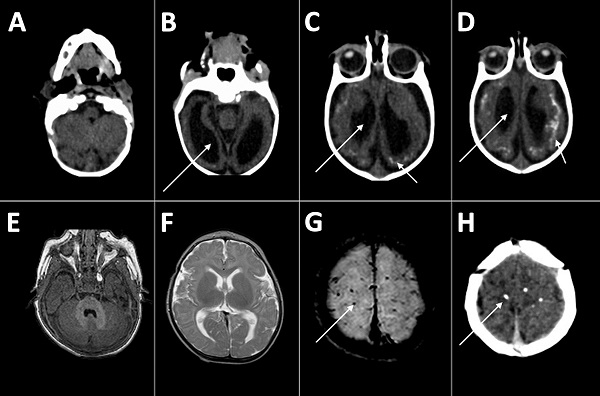 Computed tomography radiographs of the brains of 2 infants with dysphagia and microcephaly caused by congenital Zika virus infection, Brazil, 2015. A–D) Images for patient 4 show malformation of cortical development, ventriculomegaly (long arrows), and calcifications in cortical and subcortical white matter in transition between cortex and white matter (short arrows). E–H) Images for patient 6 show no malformation of cortical development or ventriculomegaly, but calcifications are visible in the