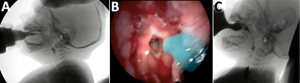 Instrumental evaluation of an infant with dysphagia and microcephaly caused by congenital Zika virus infection, Brazil, 2015. A) Videofluoroscopic swallowing study image showing a lateral view of the infant with premature spillage of liquid food (with added contrast) in the pharynx before triggering of the swallowing reflex. B) Image of the fiberoptic endoscopic evaluation of a delay in initiation of swallowing; thickened, dyed liquid is visible on the supraglottis. C) Silent aspiration, as indi