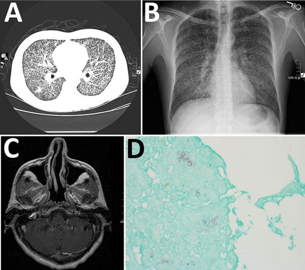 Emmonsia helica infection in an immunocompromised man, California, USA, 2016. A) Chest radiograph with diffuse micronodularities throughout both lung fields. B) Computed tomographic scan with diffuse micronodular pulmonary disease. C) Axial magnetic resonance image with 6-mm ring-enhancing lesion in the right cerebellum adjacent to the fourth ventricle. D) Grocott’s methenamine-silver stain showing broad-based budding yeast. Original magnification ×400.