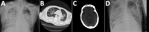 Chest and brain imaging of 56-year-old man infected with highly pathogenic avian influenza A(H7N9) virus, China, 2017: radiograph imaging of chest at day 7 (A) and day 40 (D); computed tomographic scans of the chest (B) and the brain (C) at day 30.