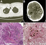 Thumbnail of Diagnostic testing of a 52-year-old woman from France living in Mali who had Nannizziopsis spp. fungal infection. A) Thoracic-abdominal-pelvic scan shows pseudo-nodular lesions in the apex of the right lung, of which one is excavated. B) Cerebral computed tomography scan shows contrast enhancement on several hemispheric nodules on the left and in frontal, parietal, and temporal regions, responsible for large surrounding edema and compression of the left lateral ventricle. The median