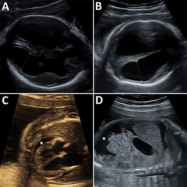 Ultrasonography of congenital microencephaly caused by infection with lymphocytic choriomeningitis virus diagnosed in the fetus of a 29-year-old pregnant women at 23 weeks’ gestation. A) Fetal brain at 23 weeks’ gestation showing symetric ventriculomegaly (14 mm). Yellow symbols indicate axis at which size of cerebral ventricle was measured. B) Fetal brain at 26 weeks’ gestation showing symetric ventriculomegaly (20 mm) and thinning of the cortical mantle. Yellow symbols indicate axis at which s
