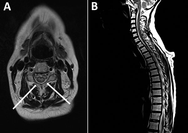 Magnetic resonance images of the brain and spinal cord of a woman who later died of fatal neurologic disease associated with enterovirus D68 infection. A) Sagittal and axial T2 image of the spinal cord showing cord swelling, particularly at the cervical level (arrows). B) Extensive hyperintensity in the central cord.