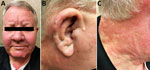 Thumbnail of Signs of Mycobacterium lepromatosis infection in 59-year-old white male US citizen, 2017. A) Leonine facies with partial loss of eyebrows and nodular lesion of chin. B) Right ear nodularity with focal crusted ulceration. C) Confluent erythema from face to neck.