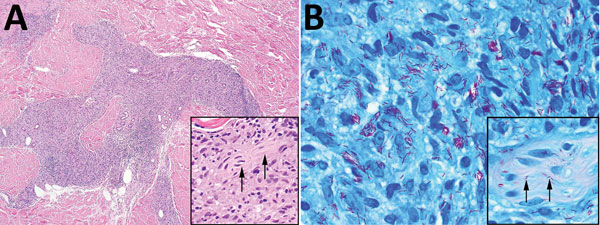 Skin biopsies of 59-year-old white male US citizen showing Mycobacterium lepromatosis infection, 2017. A) Hematoxylin and eosin–stained section of a specimen from the chin showing granulomatous dermal inflammation (original magnification ×100); inset shows nerve involvement (arrows) that is diagnostic for leprosy (original magnification ×400). B) Fite-stained section of a specimen from the chin highlights numerous acid-fast bacilli within histiocytes (original magnification ×1,000); inset shows 