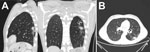 Thumbnail of Computed tomography of the lungs in patient with invasive fungal disease caused by Inonotus spp., Madrid, Spain. Images show pulmonary nodule with halo sign in the left superior lobe, with peripheral distribution. 
