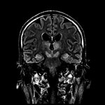 Thumbnail of Magnetic resonance imaging of brain of index patient 66 days after double lung transplantation, Hong Kong, China. Coronal FLAIR (FLuid Attenuation Inversion Recovery sequence) image of the head at the level of the lateral ventricles, thalamus, and midbrain shows high signal at bilateral thalamus, midbrain, and medial temporal lobes.