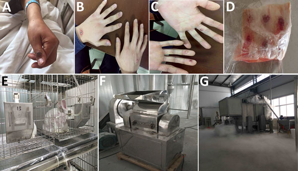 Images from outbreak of vaccinia virus (VACV) from occupational exposure, China, March 2017. A) Lesion on thumb of case-patient 1; B, C) lesions on hands of case-patient 2; D) batch of frozen rabbit skin inoculated with VACV by a biopharmaceutical laboratory; E) live rabbit after VACV inoculation in the biopharmaceutical laboratory; F) machine used to pulverize rabbit skin; G) closed workspace where 5 case-patients pulverized rabbit skin. 