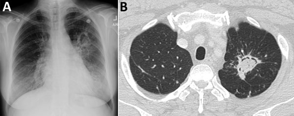 A) Chest radiograph showing aspergilloma (fungal ball) in the left upper lung lobe. B) Axial computed tomography image shows increased density in an irregular left apical cavity, a sequela of pulmonary tuberculosis, consistent with an aspergilloma.