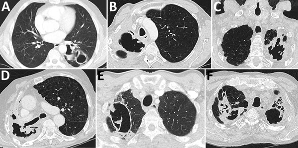 Computed tomography images showing early features of fungal ball formation in pulmonary cavities. A) Two left lower lung lobe posterior thick-walled cavities, 1 with a fluid level. B) Two right apical cavities, the larger with an irregular interior wall, most consistent with fungal growth. C) Left apex replaced by an irregular thick-walled cavity with multiple areas of fungal growth on the interior surface of the cavity. D) Substantial volume loss in the right upper lobe with replacement by a sm