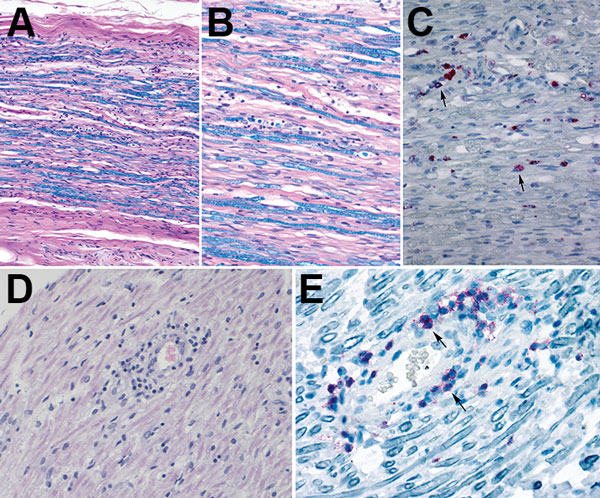 Histopathologic evaluation of tissue specimens collected postmortem from a patient with Guillain-Barré syndrome (acute demyelinating inflammatory polyneuropathy variant) and Zika virus infection, Puerto Rico, 2016. A, B) Luxol fast blue-periodic acid-Schiff myelin stain of sciatic nerves show patchy myelin loss and variable inflammation. Original magnification x10(A) and x20(B). C) Detection of CD68 cells by immunohistochemistry (arrows) in sciatic nerve. Original magnification x20. D) Hematoxyl